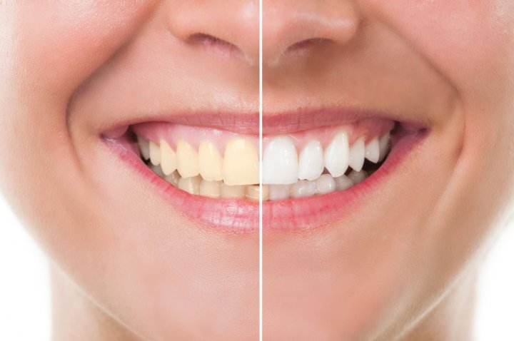 Oralduero clínica dental en Aranda de Duero tratamientos estética dental blanqueamiento