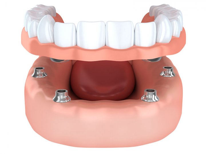 Oralduero clínica dental en Aranda de Duero tratamientos implantes prótesis