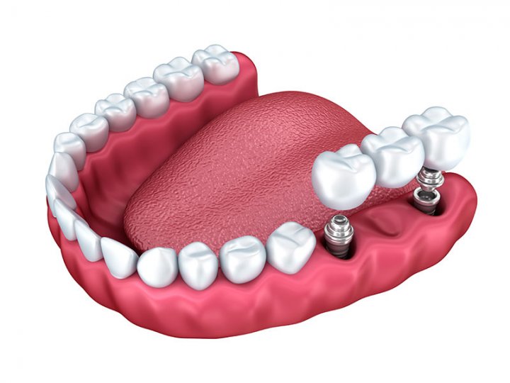 Oralduero clínica dental en Aranda de Duero tratamientos implantes puente