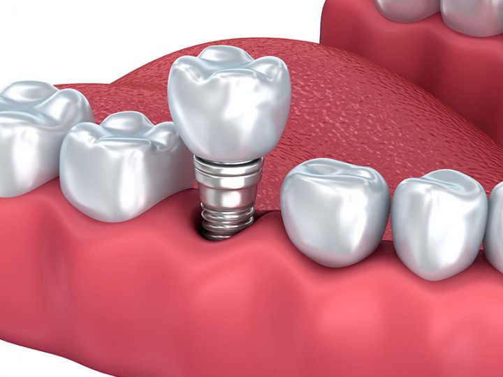 Oralduero clínica dental en Aranda de Duero tratamientos implantes unitario