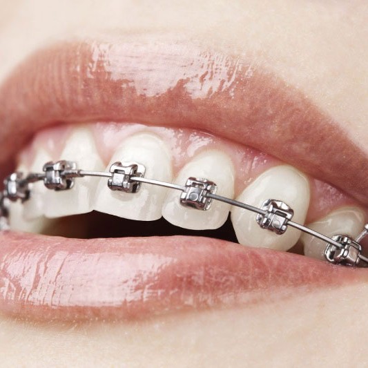 Oralduero clínica dental en Aranda de Duero tratamientos ortodoncia bráckets autoliglables