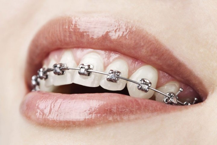 Oralduero clínica dental en Aranda de Duero tratamientos ortodoncia bráckets autoliglables