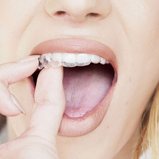 Oralduero clínica dental en Aranda de Duero tratamientos ortodoncia invisible