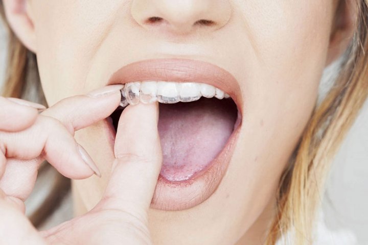 Oralduero clínica dental en Aranda de Duero tratamientos ortodoncia invisible