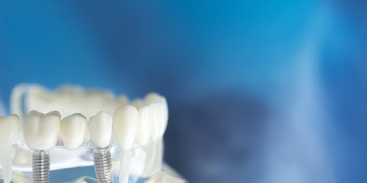 Dentistas en Aranda de Duero, Implantología Oral en Aranda de Duero
