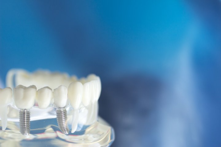 Dentistas en Aranda de Duero, Implantología Oral en Aranda de Duero