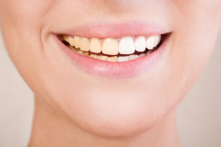 Blanqueamiento dental en Aranda del Duero