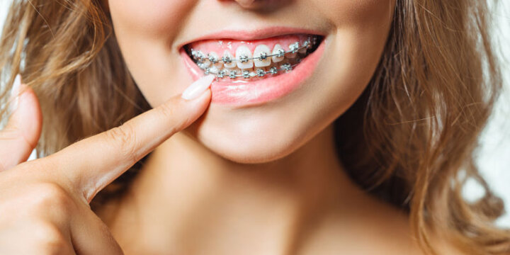 Ortodoncia con brackets autoligables