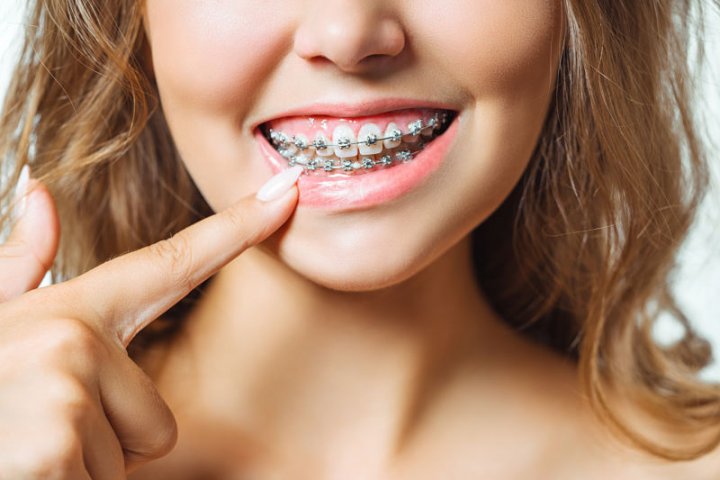 Ortodoncia con brackets autoligables