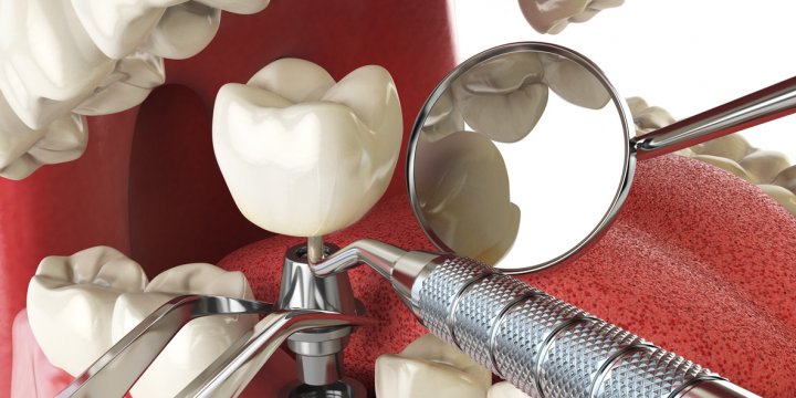 implantes dentales