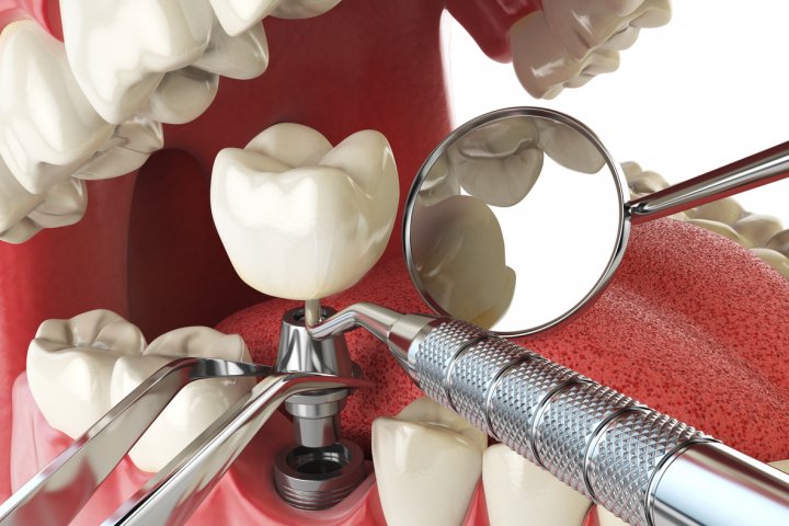 implantes dentales