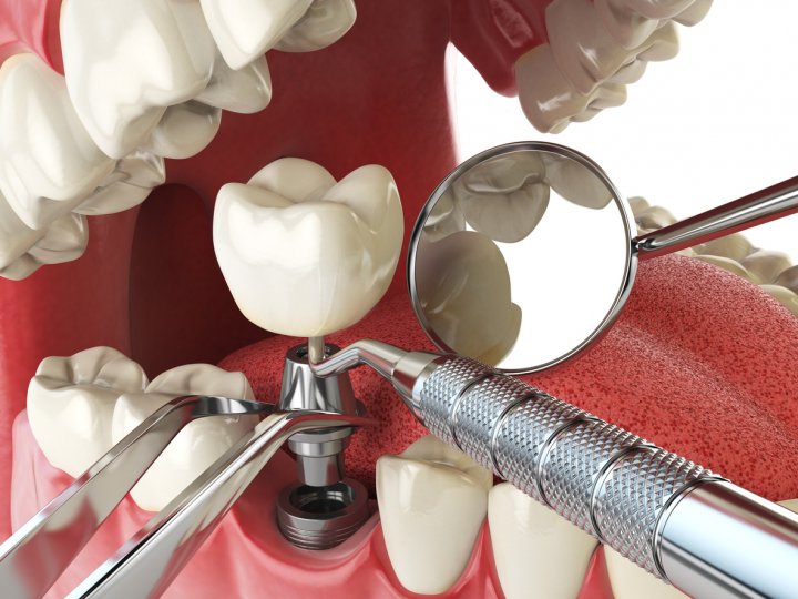 implantes dentales